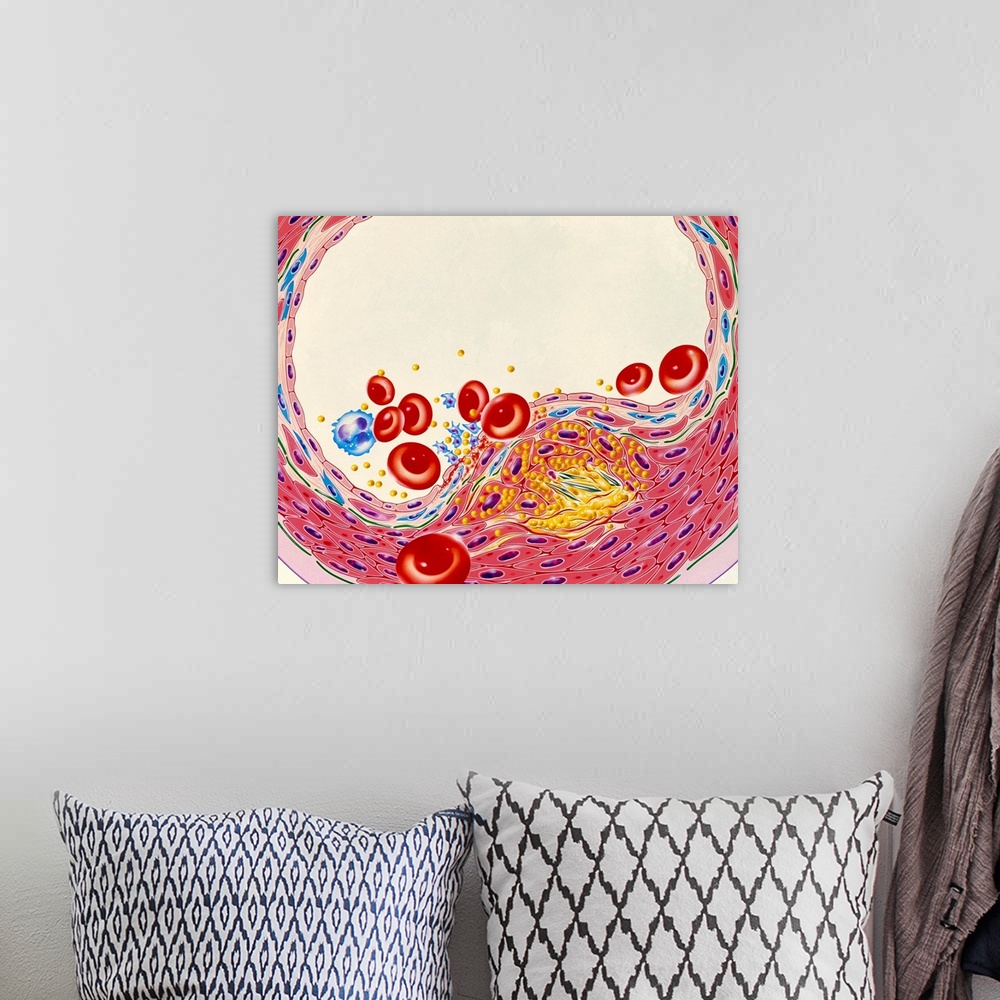 A bohemian room featuring Atherosclerosis. Illustration of a cross-section through an artery narrowed by atherosclerosis. F...
