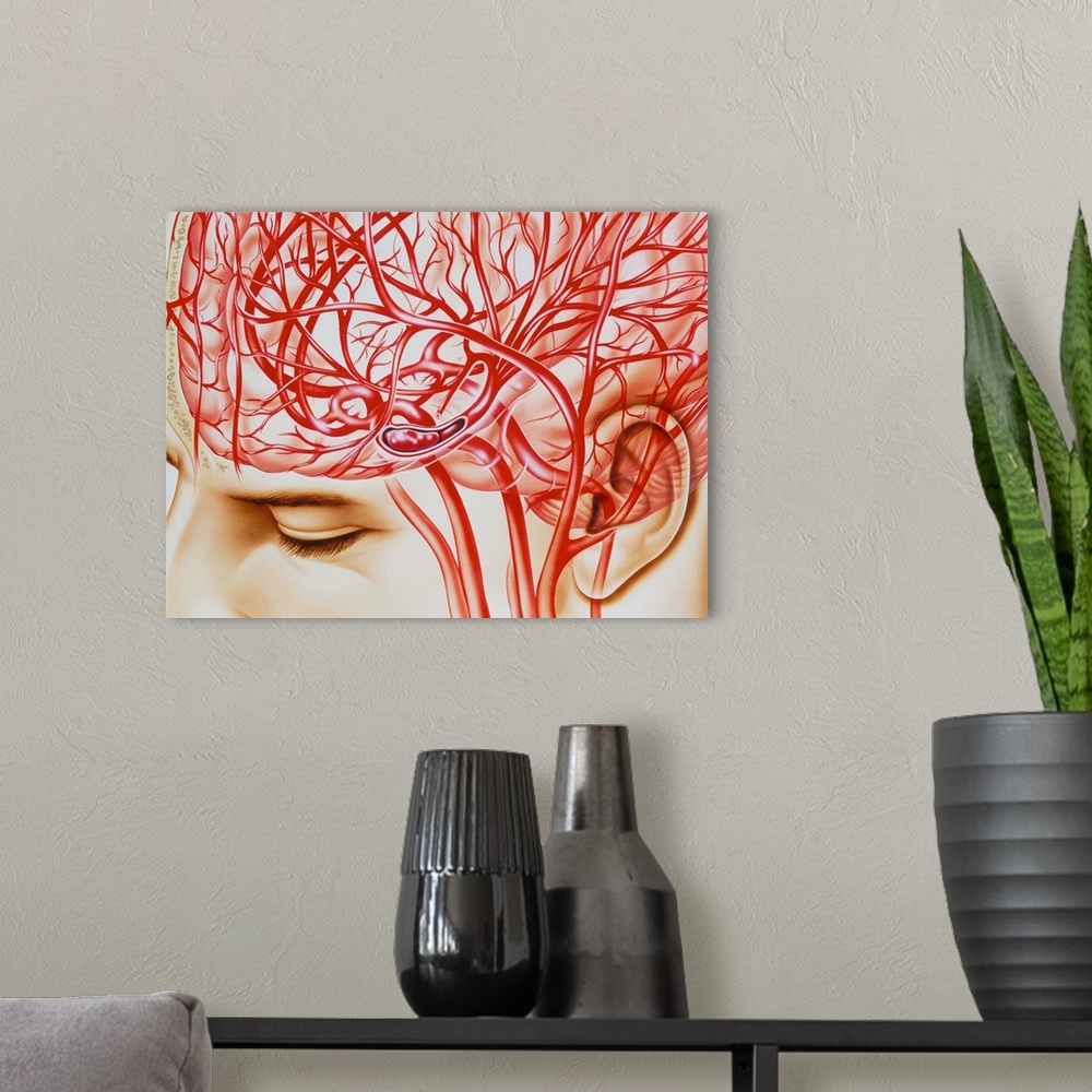 A modern room featuring Cerebral embolism. Artwork of the blood supply to the head showing an embolism (blockage) in the ...