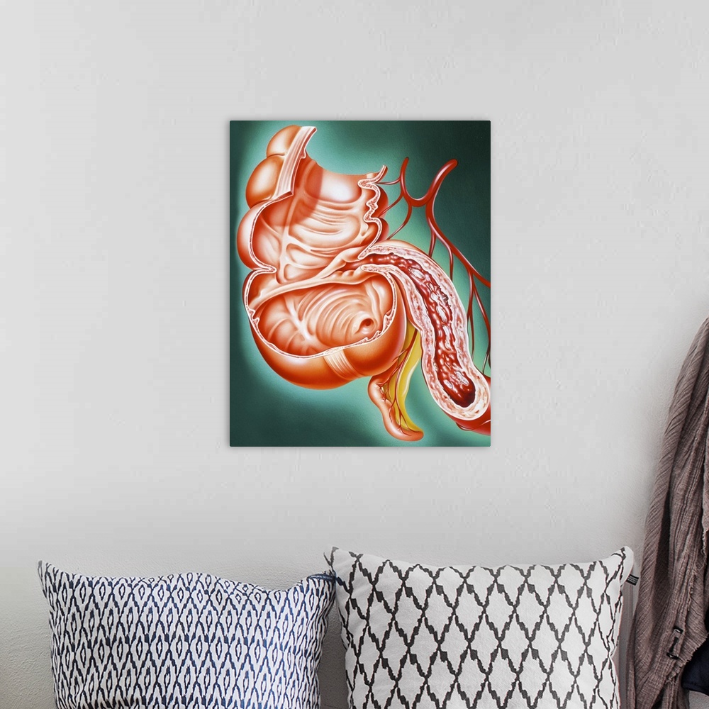 A bohemian room featuring Crohn's disease. Artwork of a section through part of the human digestive tract, showing the smal...