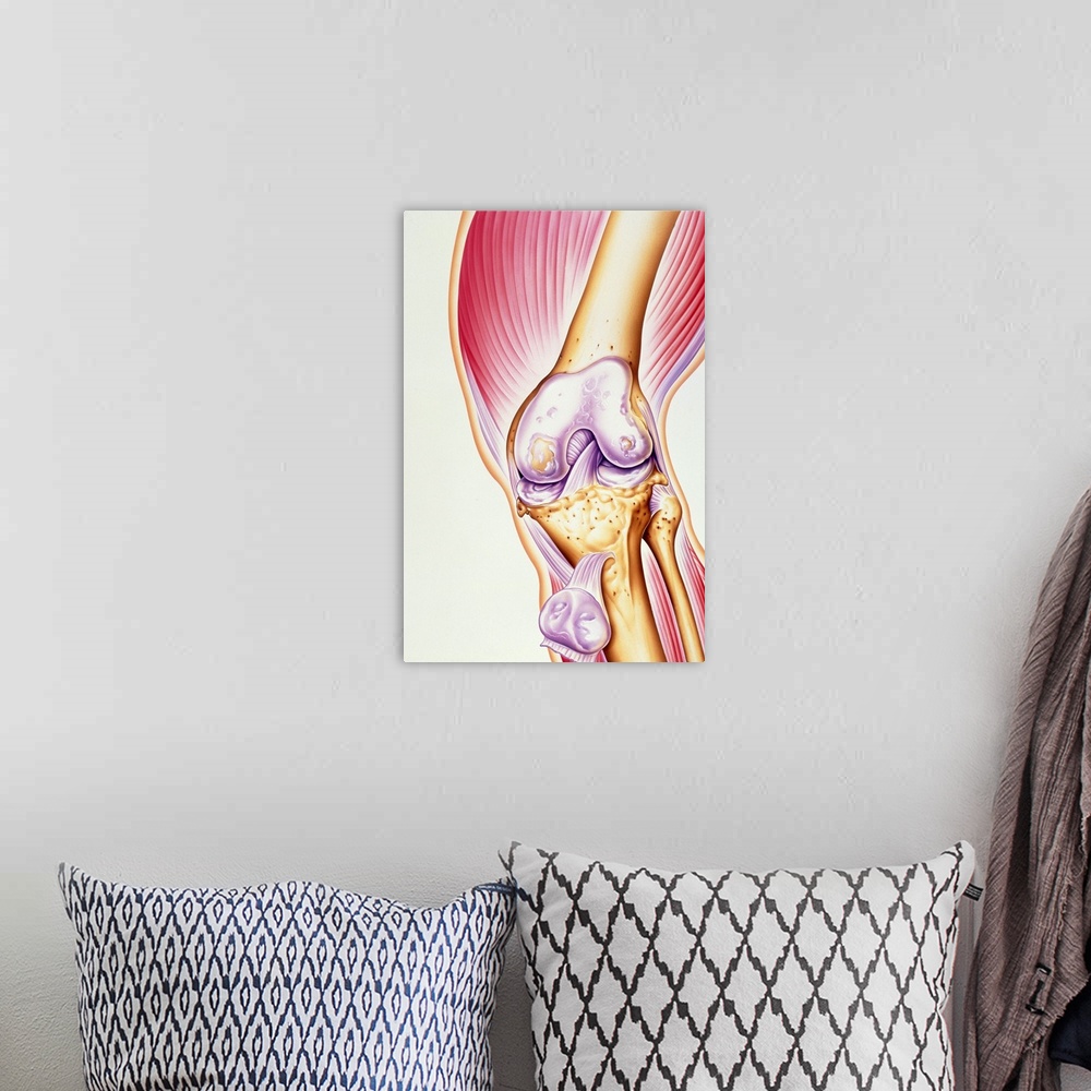 A bohemian room featuring Osteoarthritis of knee. Illustration of the joint of a human knee affected by osteoarthritis. The...