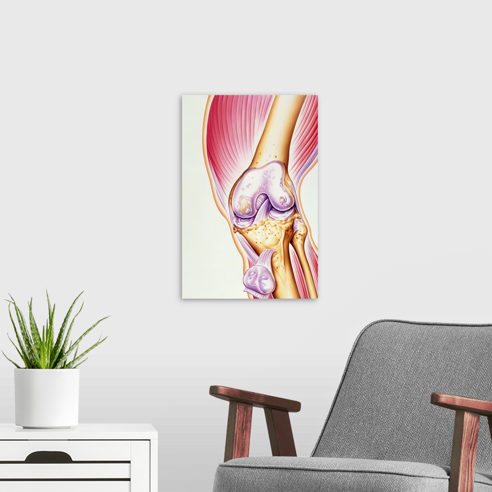 A modern room featuring Osteoarthritis of knee. Illustration of the joint of a human knee affected by osteoarthritis. The...