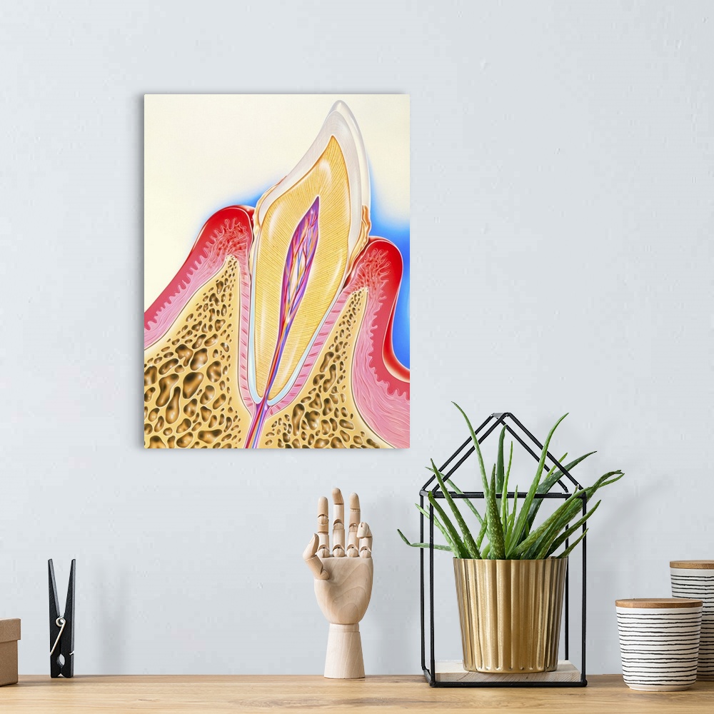 A bohemian room featuring Periodontal disease. Artwork of a section through a human tooth with periodontal disease of its s...