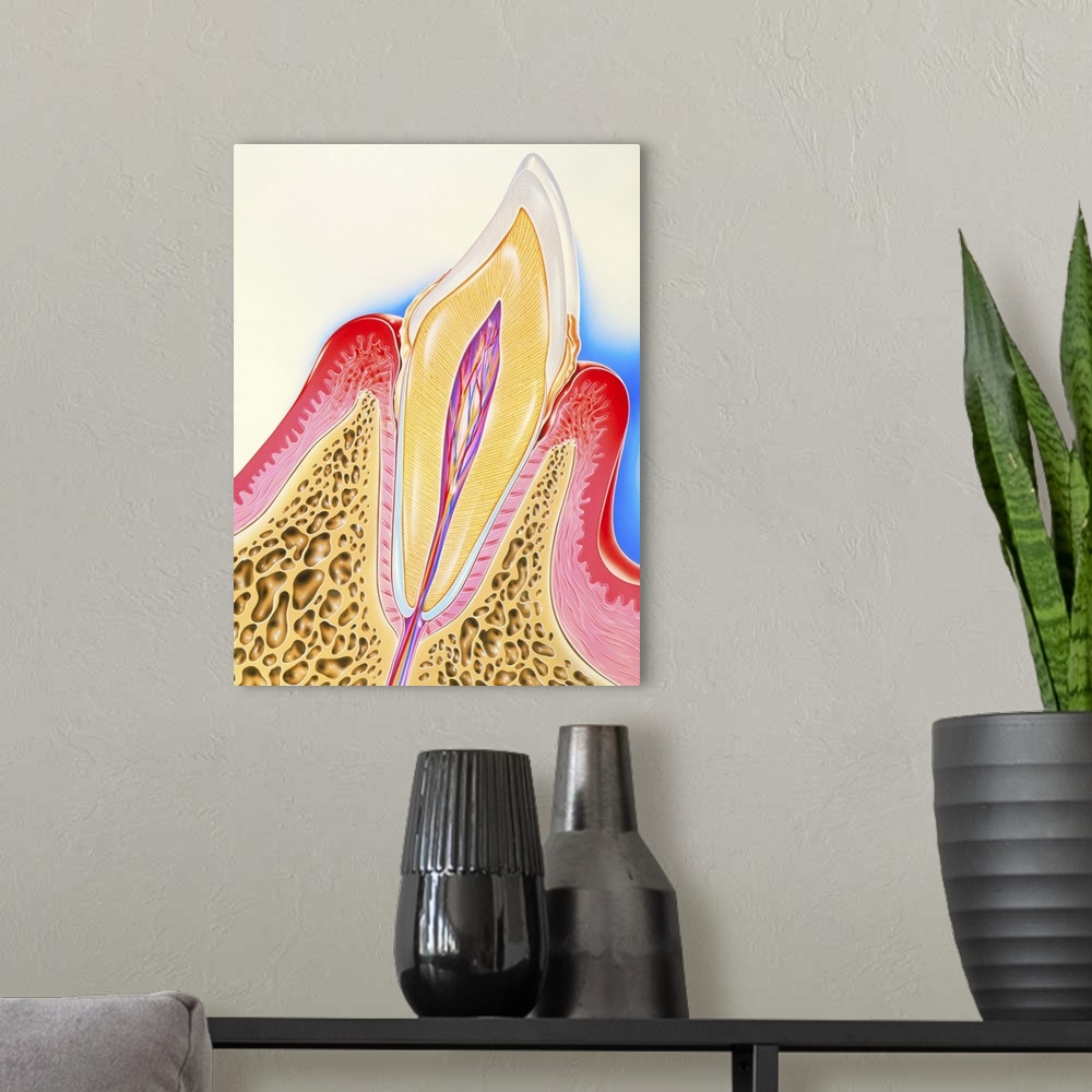 A modern room featuring Periodontal disease. Artwork of a section through a human tooth with periodontal disease of its s...