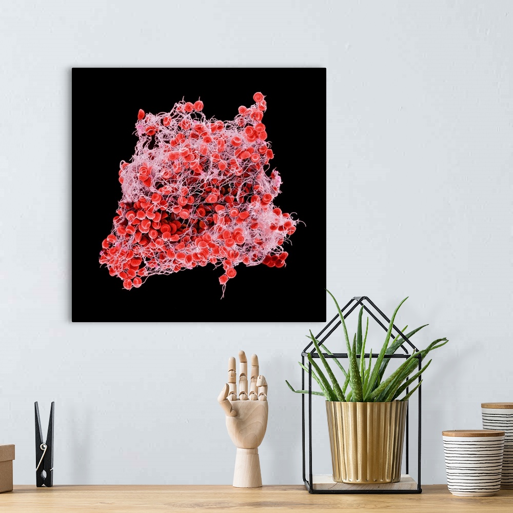 A bohemian room featuring Blood clot, coloured scanning electron micrograph (SEM). Red blood cells (erythrocytes) are trapp...