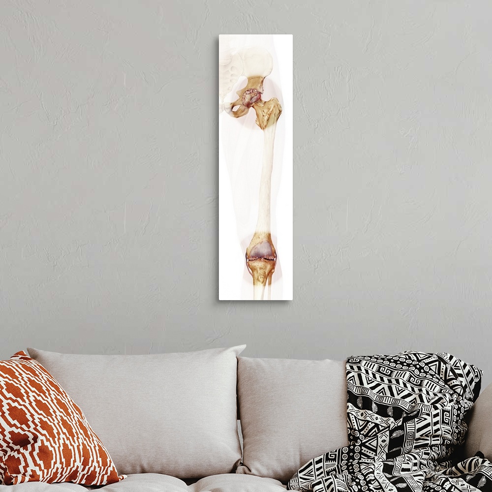 A bohemian room featuring Bone death. Computer artwork of a human hip and knee joint affected by osteonecrosis - death of t...