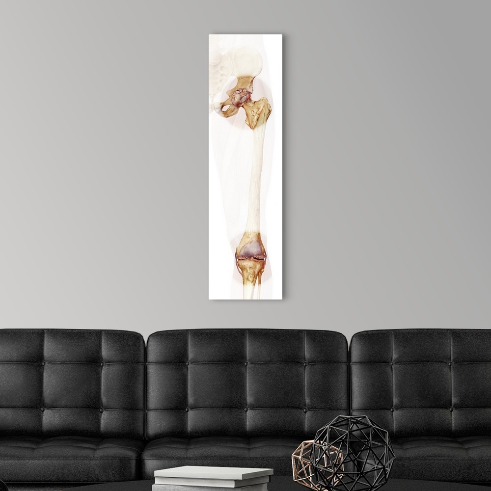 A modern room featuring Bone death. Computer artwork of a human hip and knee joint affected by osteonecrosis - death of t...