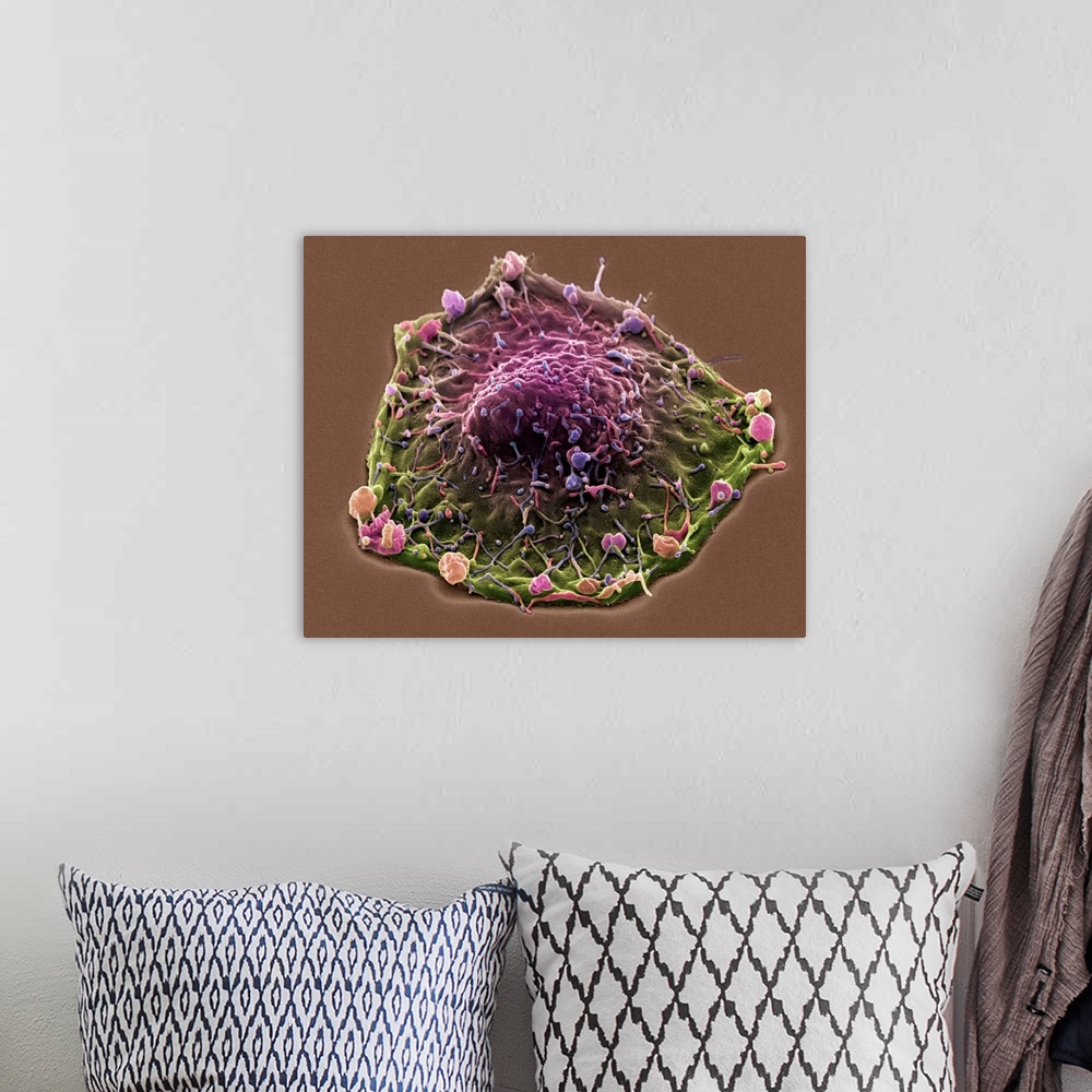 A bohemian room featuring Colon cancer. Coloured scanning electron micrograph (SEM) of a cancer cell from the human colon (...