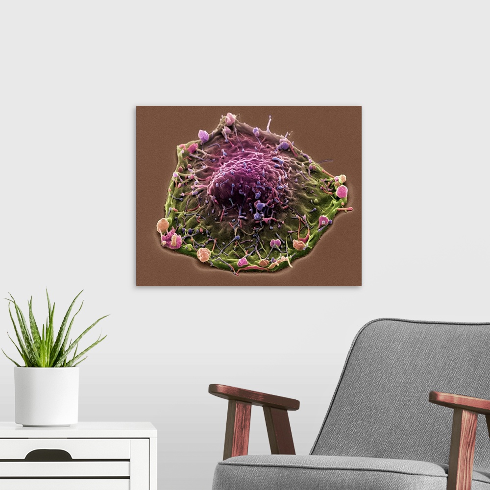 A modern room featuring Colon cancer. Coloured scanning electron micrograph (SEM) of a cancer cell from the human colon (...