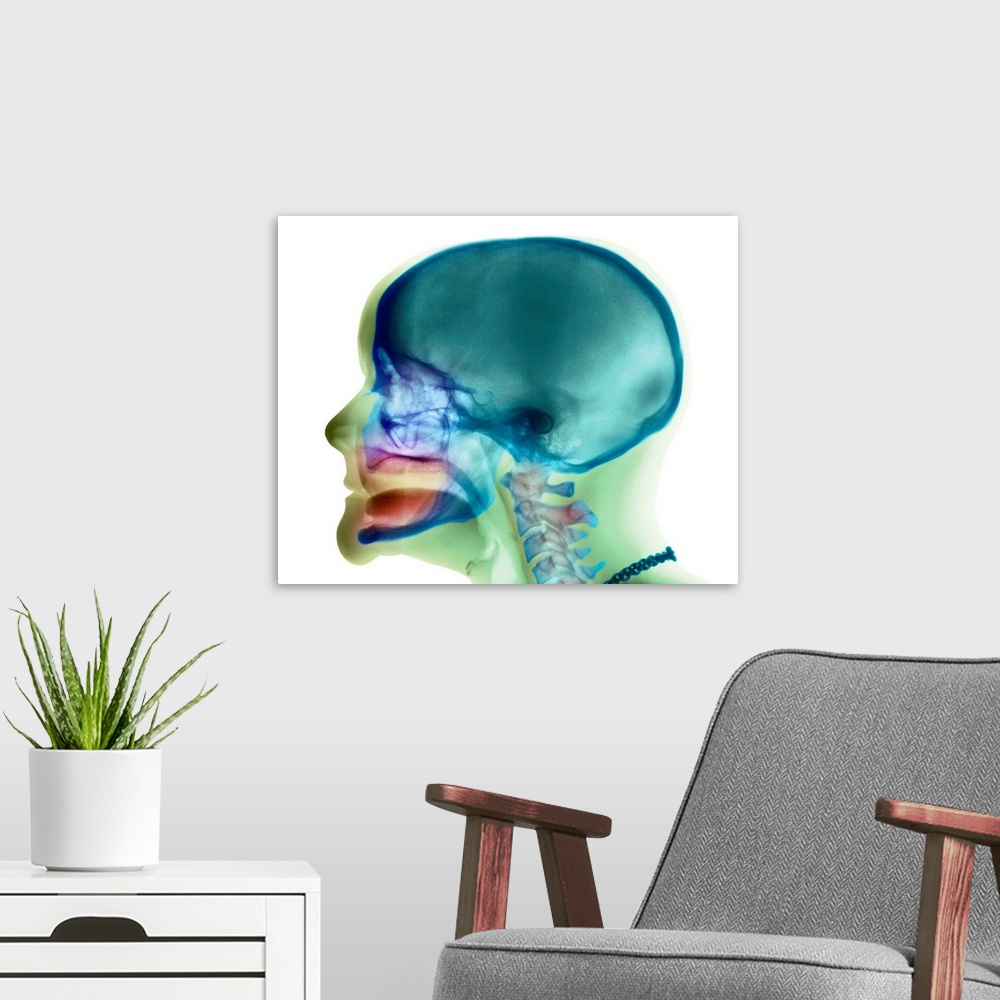 A modern room featuring Loss of teeth. Coloured X-ray (side view) of the head of a 49 year old woman showing complete los...