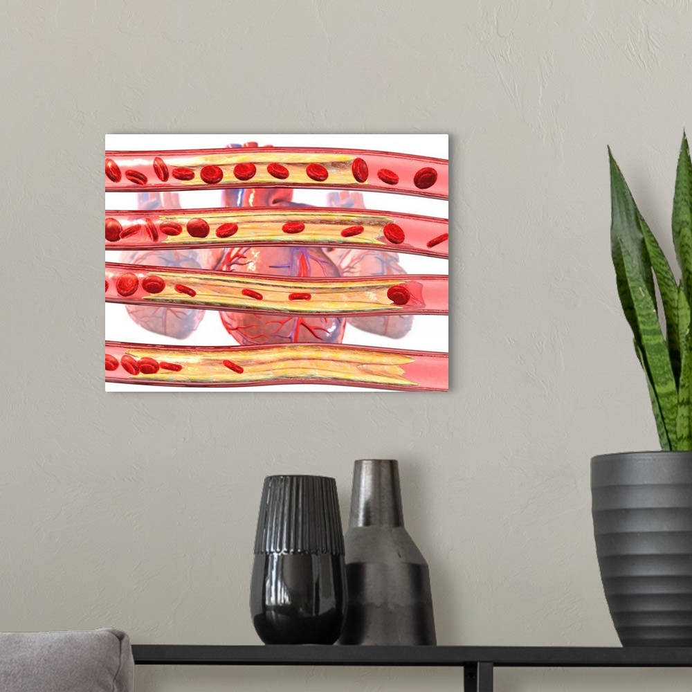 A modern room featuring Coronary artery disease. Computer artwork of red blood cells flowing through an increasingly (top...