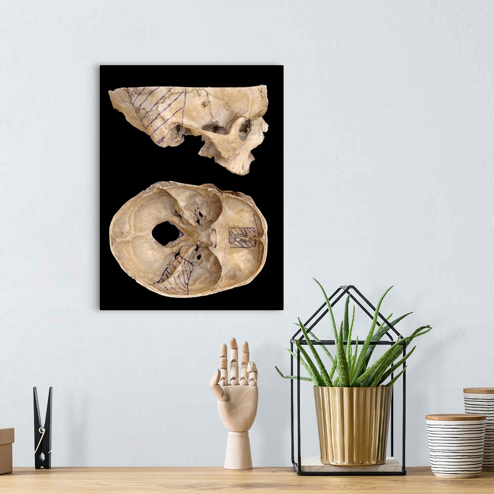 A bohemian room featuring Craniofacial surgery approaches. Skulls showing surgical approaches to two tumour locations at th...