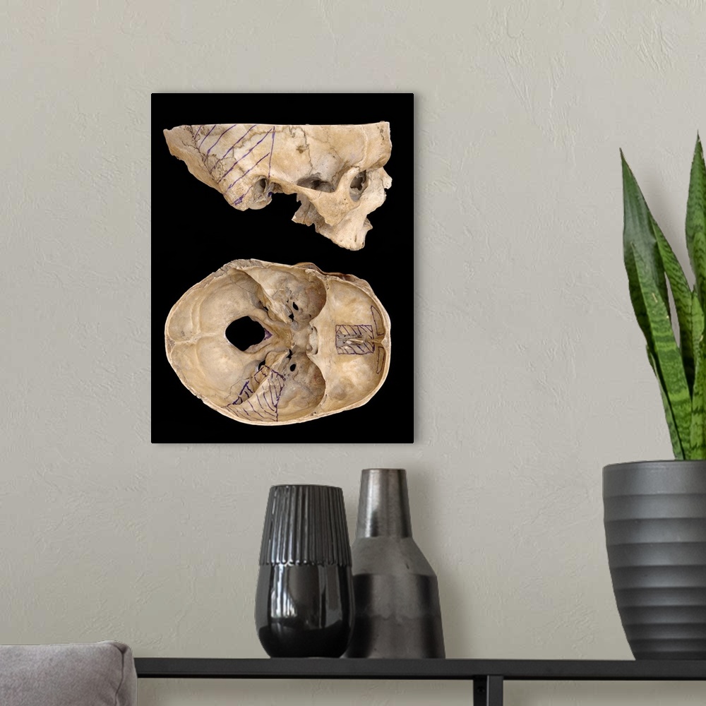 A modern room featuring Craniofacial surgery approaches. Skulls showing surgical approaches to two tumour locations at th...