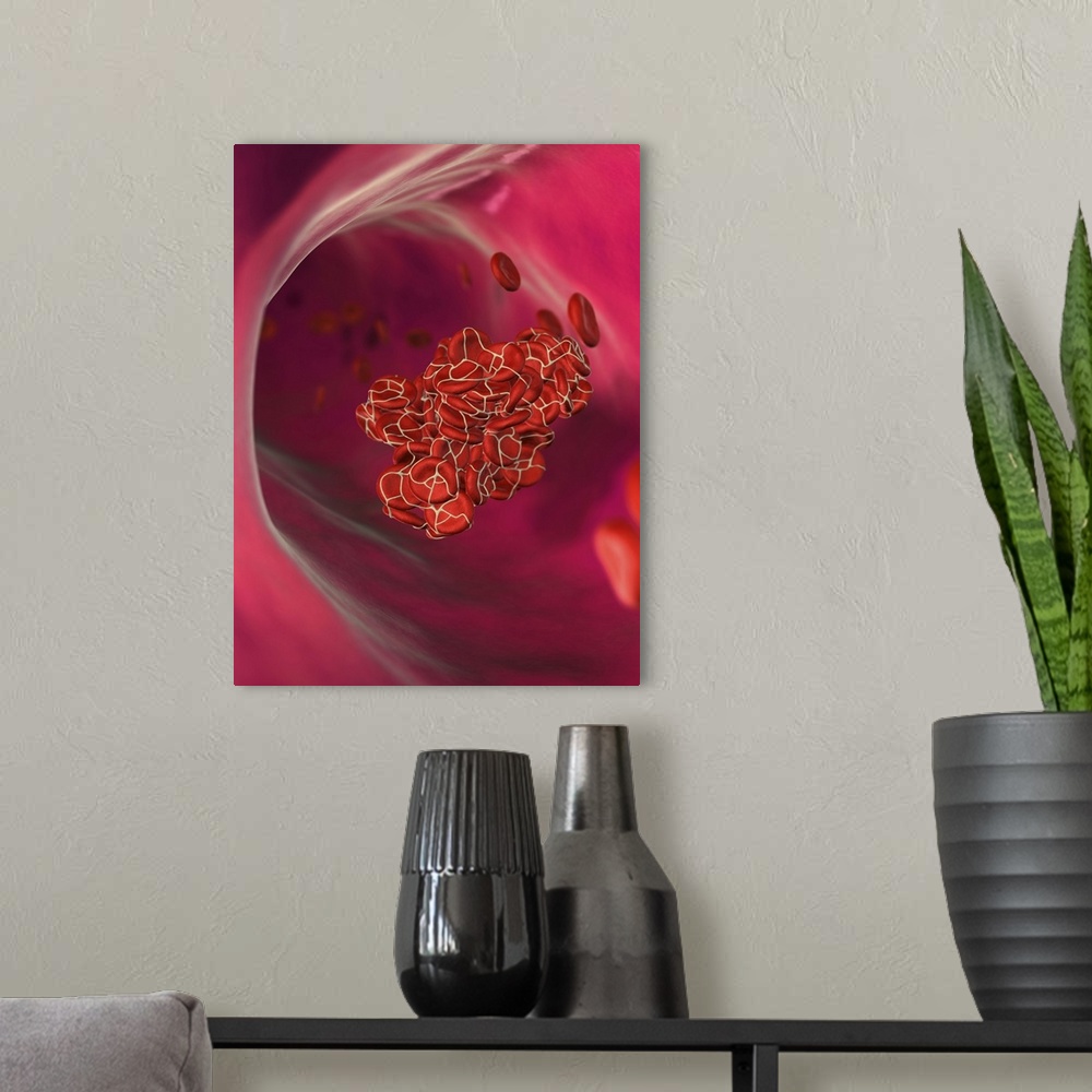 A modern room featuring Detached blood clot. Computer artwork of an embolus (detached blood clot) in a blood vessel. The ...