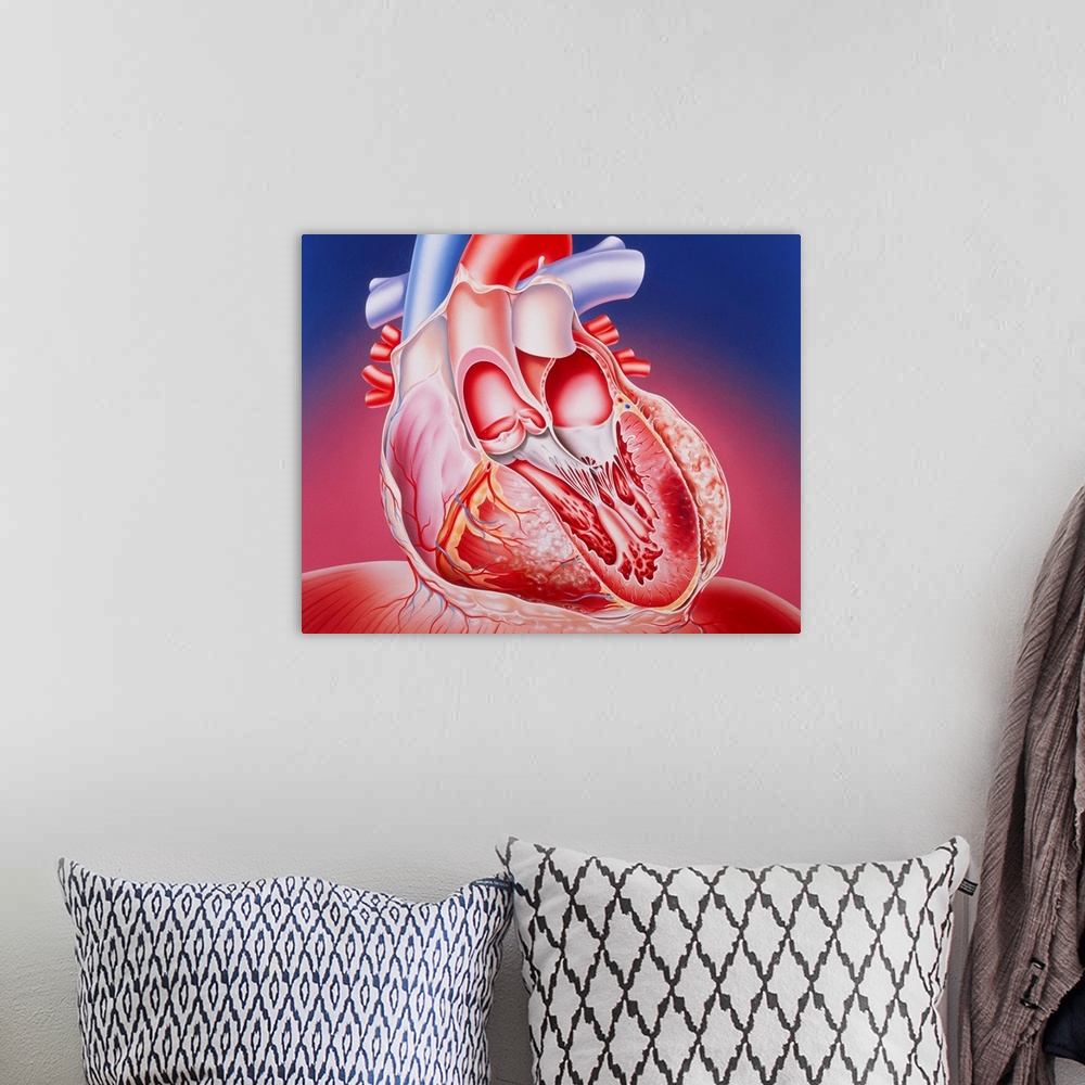 A bohemian room featuring Post-infarction heart. Illustration of a partly dissected human heart showing muscle damage cause...