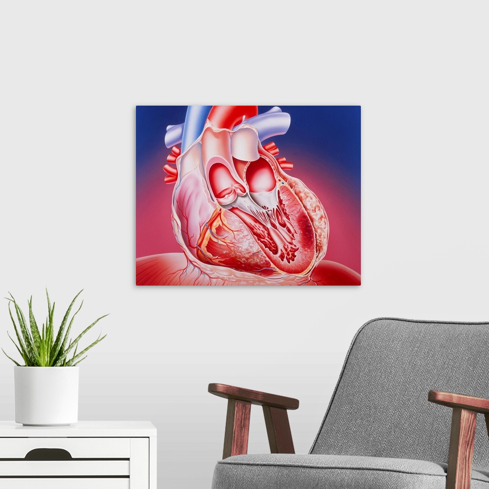 A modern room featuring Post-infarction heart. Illustration of a partly dissected human heart showing muscle damage cause...