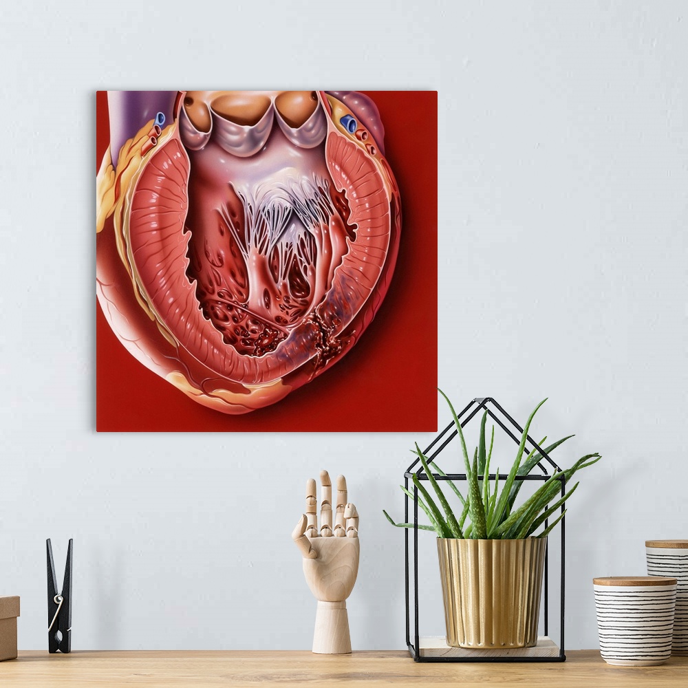 A bohemian room featuring Heart disease. Computer artwork of a sectioned heart showing a myocardial rupture (bottom right) ...