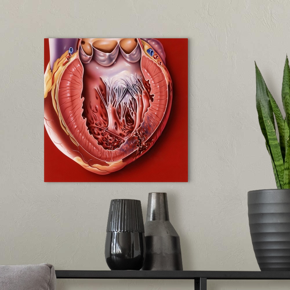 A modern room featuring Heart disease. Computer artwork of a sectioned heart showing a myocardial rupture (bottom right) ...