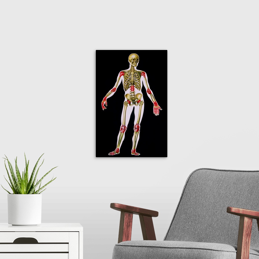 A modern room featuring Illustration of arthritis sites on the body. Arthritis is not a single disorder but the name for ...