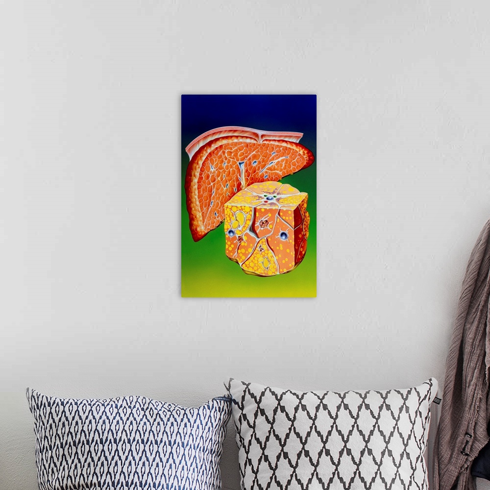 A bohemian room featuring Illustration of septal cirrhosis of the liver. Cirrhosis is a liver disease resulting in chronic ...