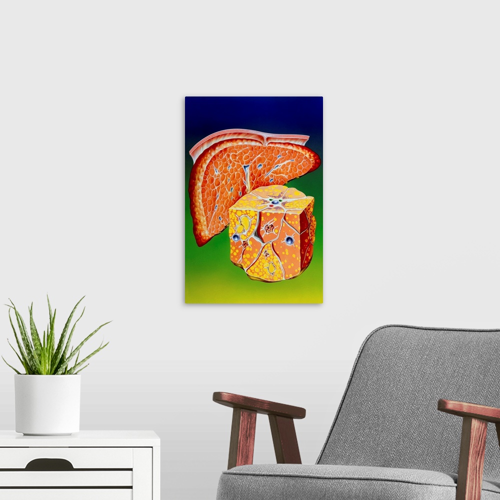 A modern room featuring Illustration of septal cirrhosis of the liver. Cirrhosis is a liver disease resulting in chronic ...