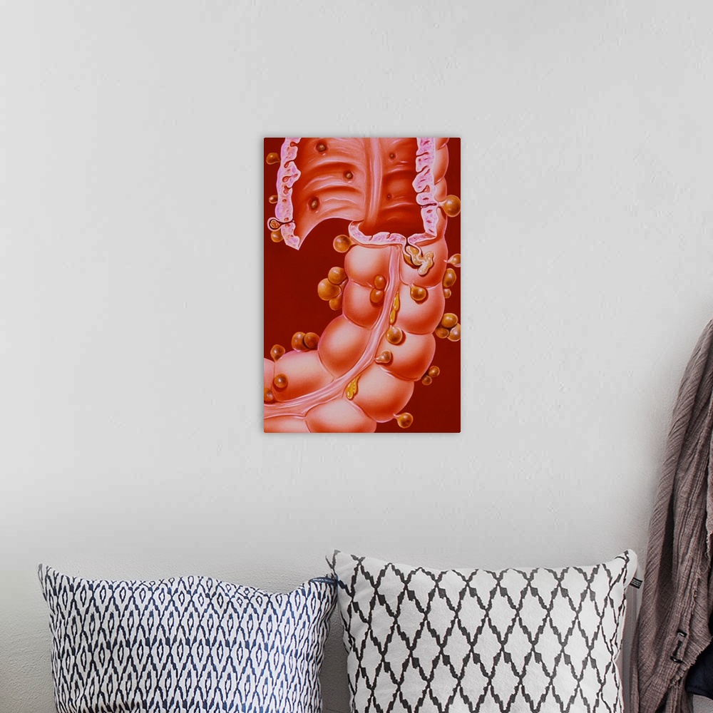A bohemian room featuring Diverticulitis. Illustration of a region of the descending colon of the human intestine, showing ...