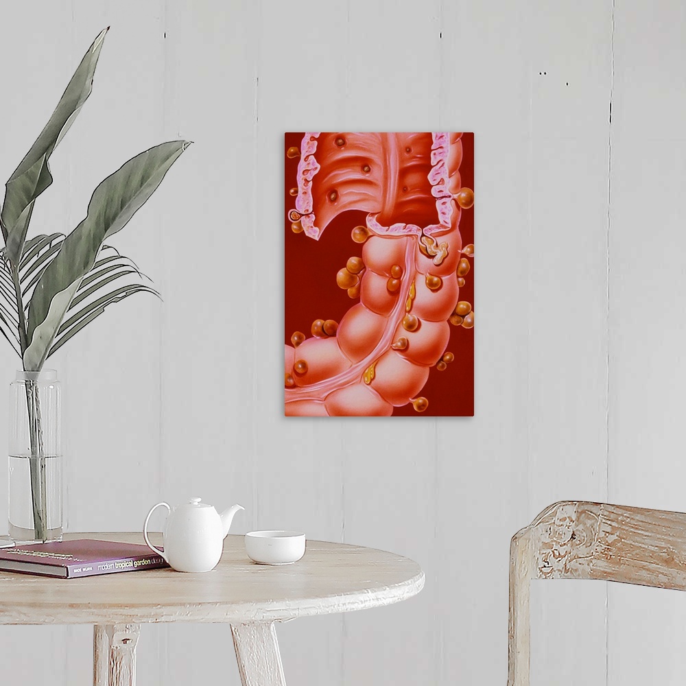 A farmhouse room featuring Diverticulitis. Illustration of a region of the descending colon of the human intestine, showing ...