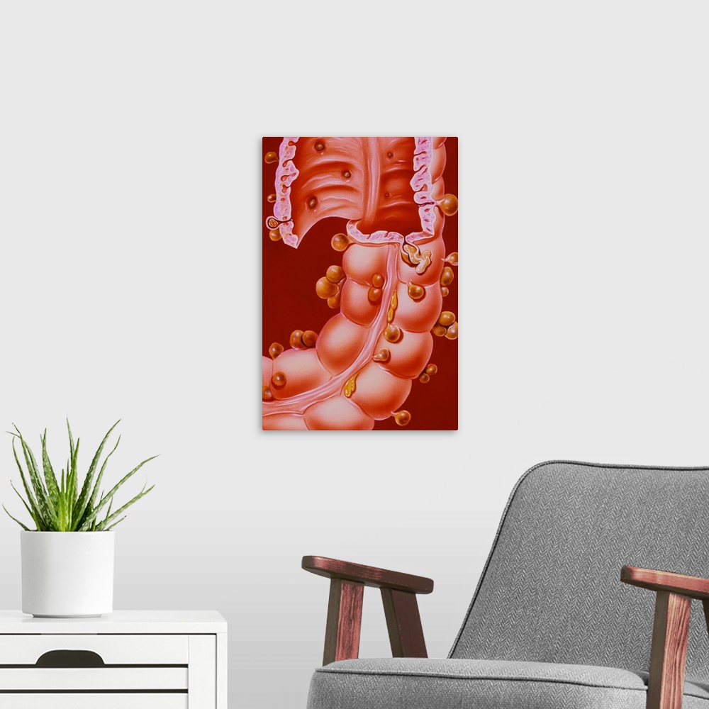 A modern room featuring Diverticulitis. Illustration of a region of the descending colon of the human intestine, showing ...