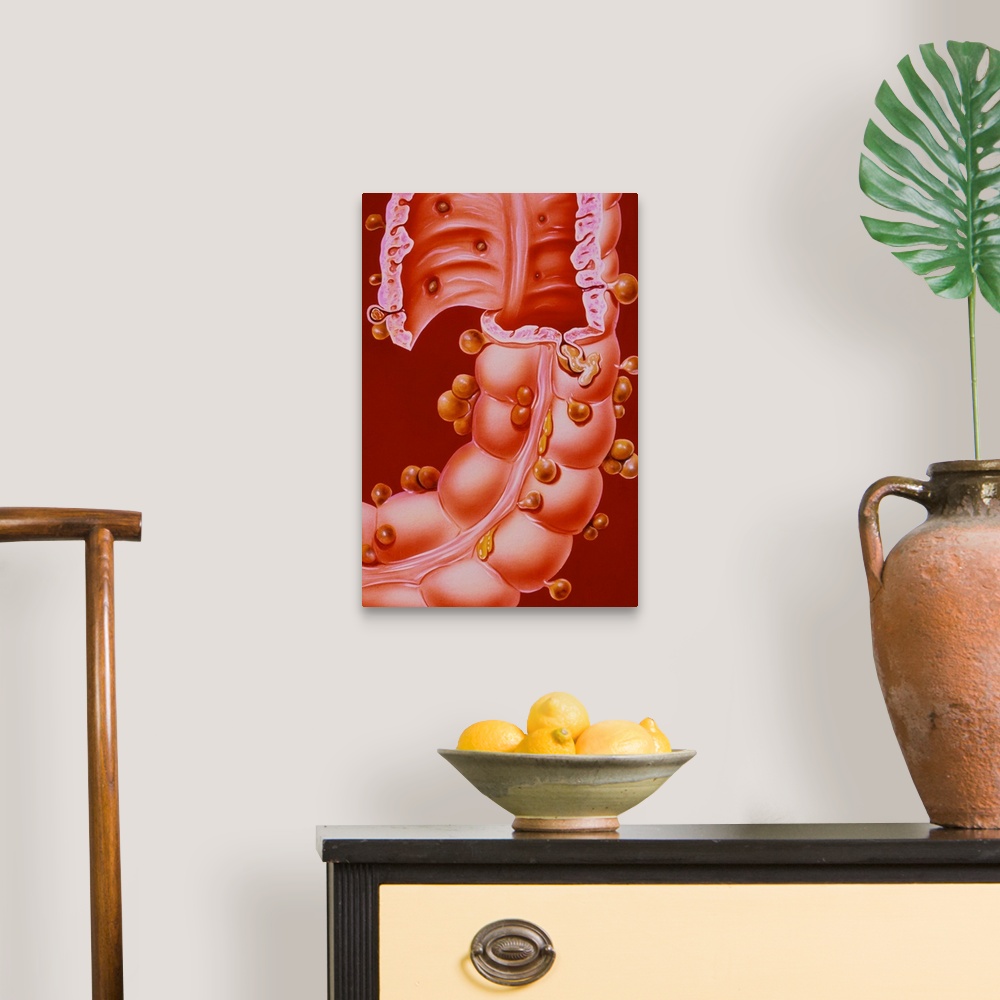 A traditional room featuring Diverticulitis. Illustration of a region of the descending colon of the human intestine, showing ...