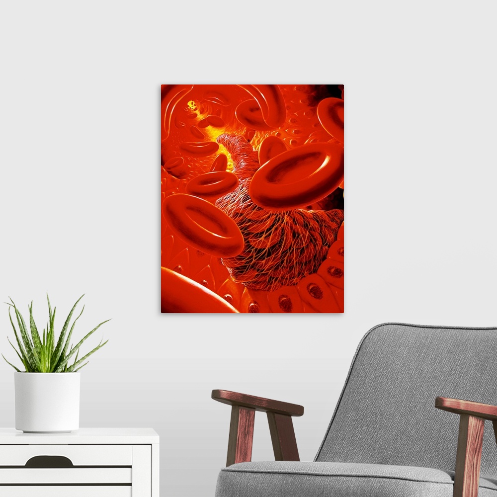 A modern room featuring Illustration of the interior of a human blood vessel, showing a snake-like thrombus (blood clot) ...