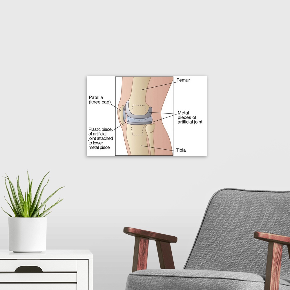 A modern room featuring Knee replacement. Artwork of a profile view of a prosthetic knee joint. The prostheses are implan...