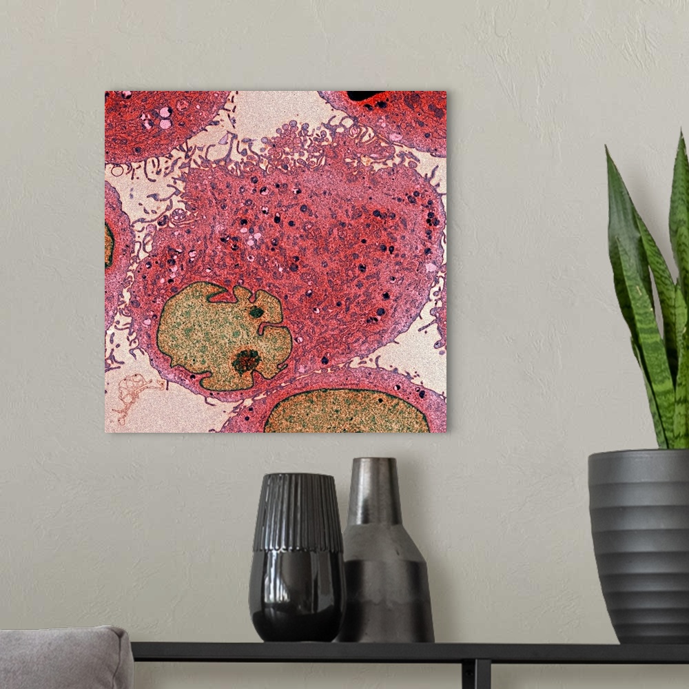 A modern room featuring Leukaemia cells in a patient with Bloom's syndrome, coloured transmission electron micrograph (TE...