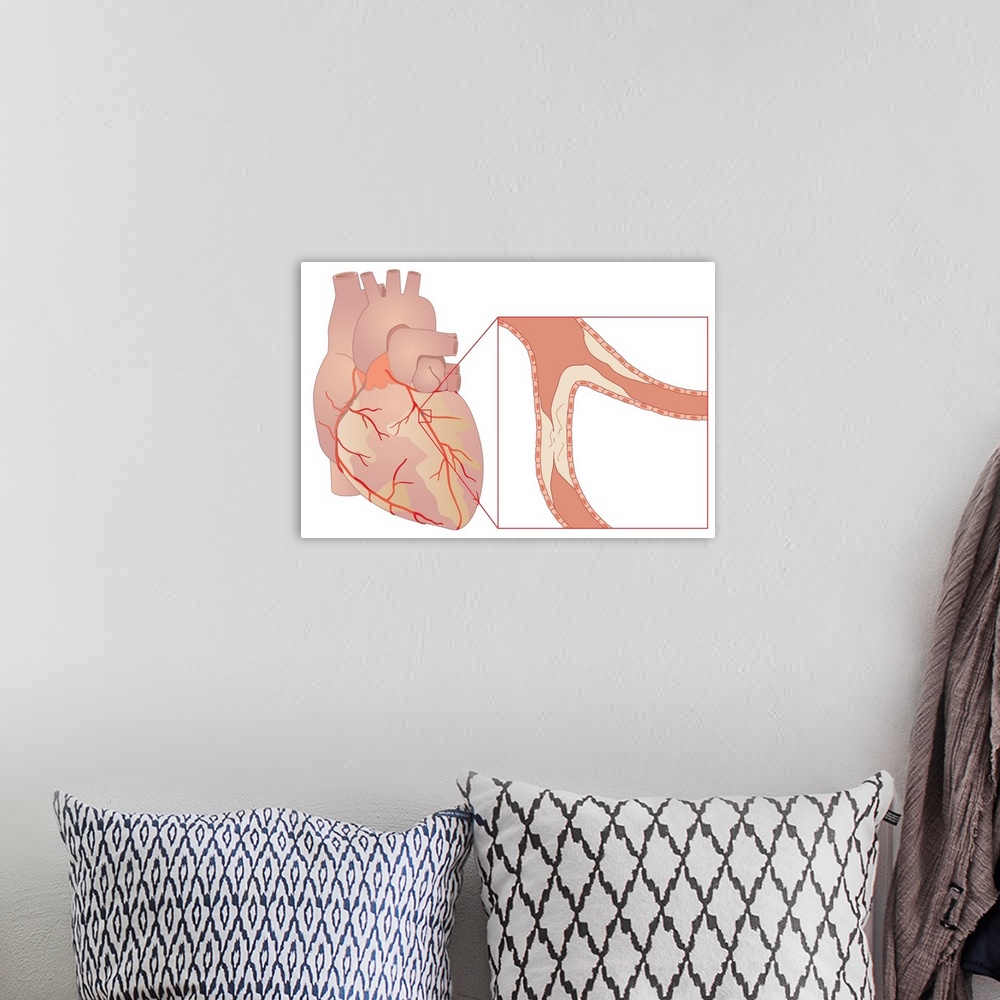 A bohemian room featuring Narrowed coronary artery. Artwork showing a coronary artery that is blocked by atheroma (cream). ...
