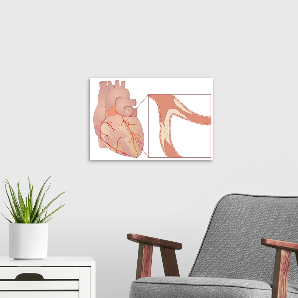 A modern room featuring Narrowed coronary artery. Artwork showing a coronary artery that is blocked by atheroma (cream). ...