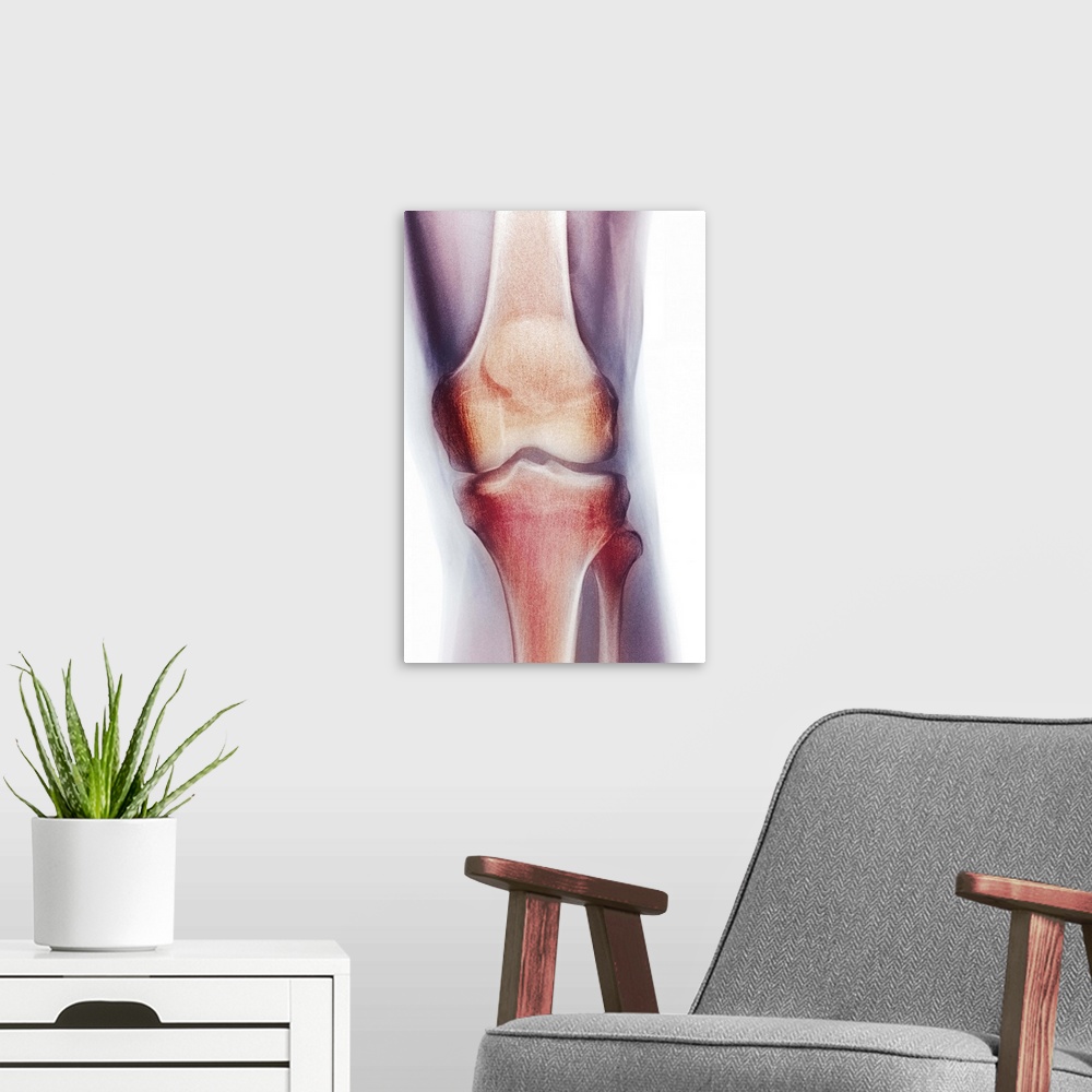 A modern room featuring Normal knee, coloured frontal X-ray. The tibia (shin bone, bottom centre) and the smaller fibula ...