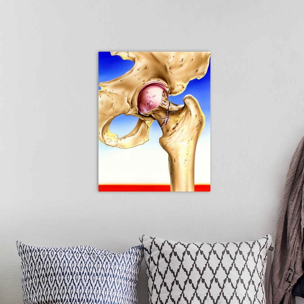 A bohemian room featuring Osteoporosis. Artwork of a hip joint where the neck of the femur (thigh bone) has fractured due t...