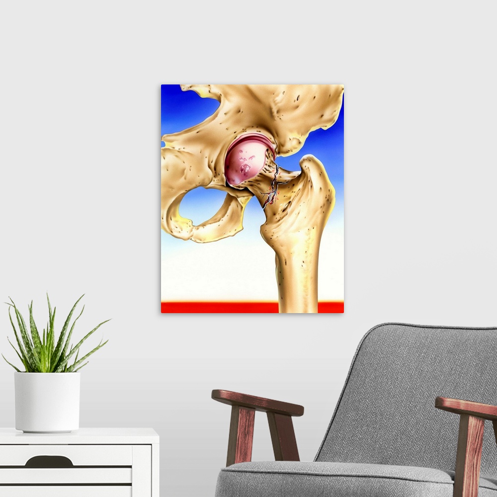 A modern room featuring Osteoporosis. Artwork of a hip joint where the neck of the femur (thigh bone) has fractured due t...
