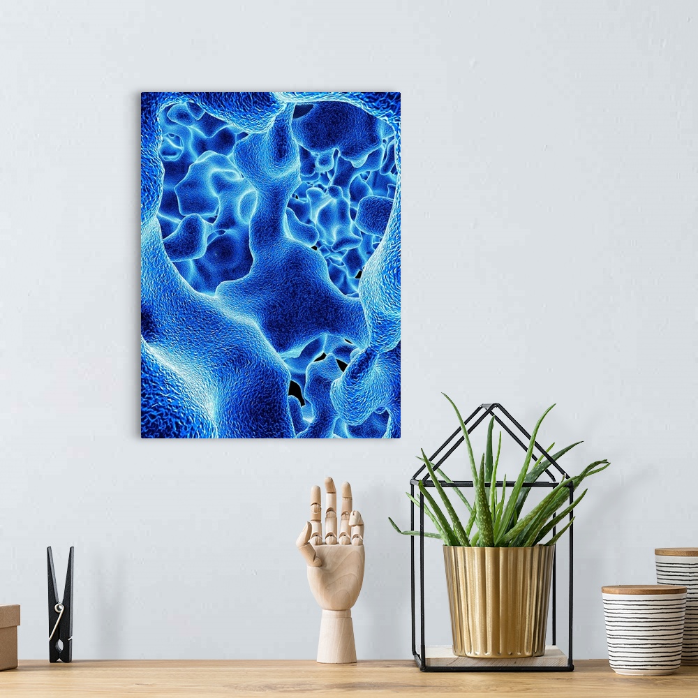 A bohemian room featuring Osteoporosis. Computer artwork of the trabeculae in the cancellous (spongy) bone tissue affected ...