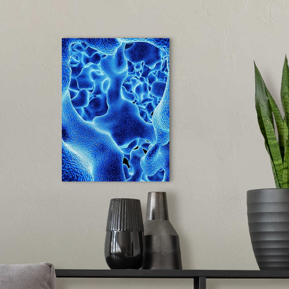 A modern room featuring Osteoporosis. Computer artwork of the trabeculae in the cancellous (spongy) bone tissue affected ...