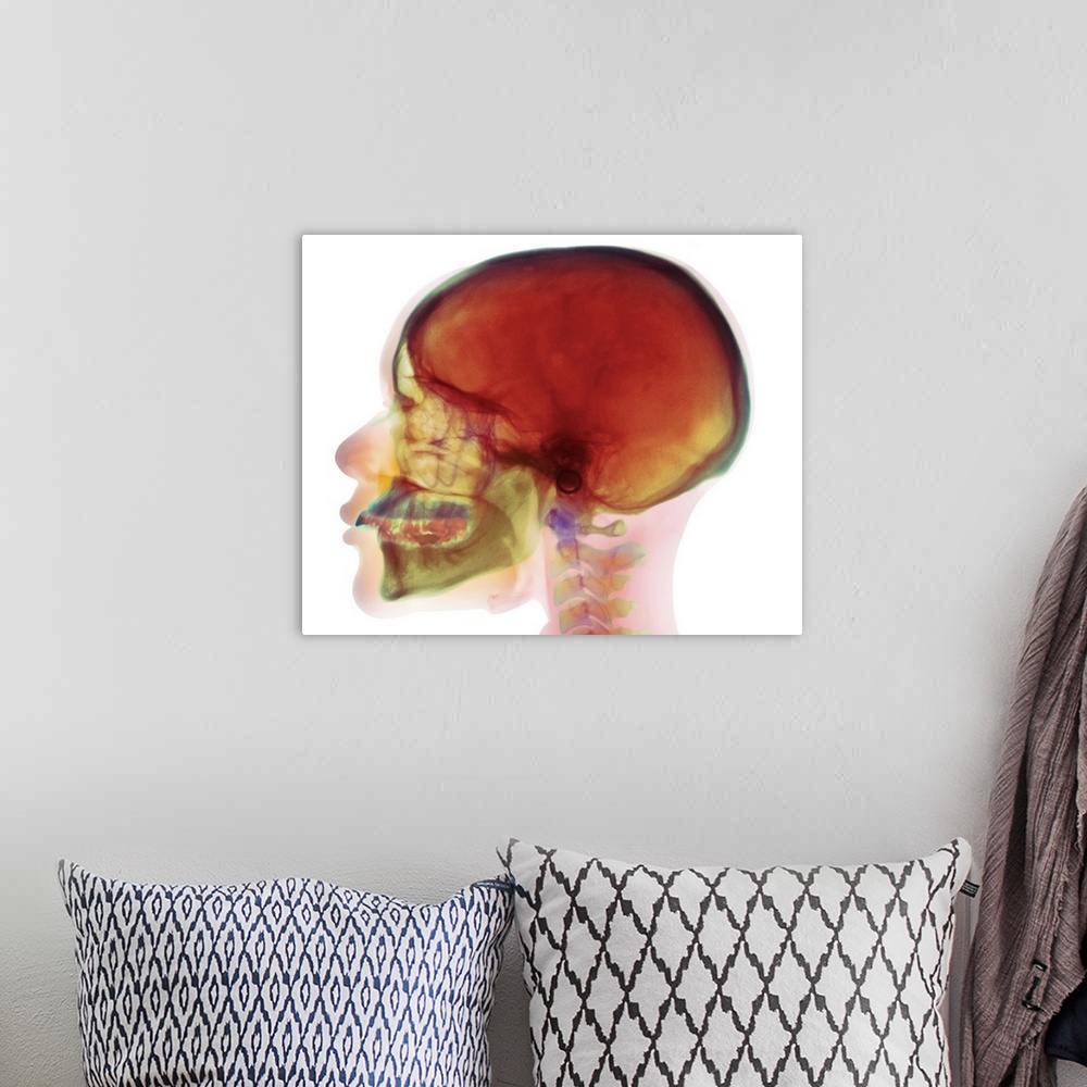 A bohemian room featuring Overbite. Coloured X-ray (side view) of the head of a 32 year old woman showing overbite of the u...