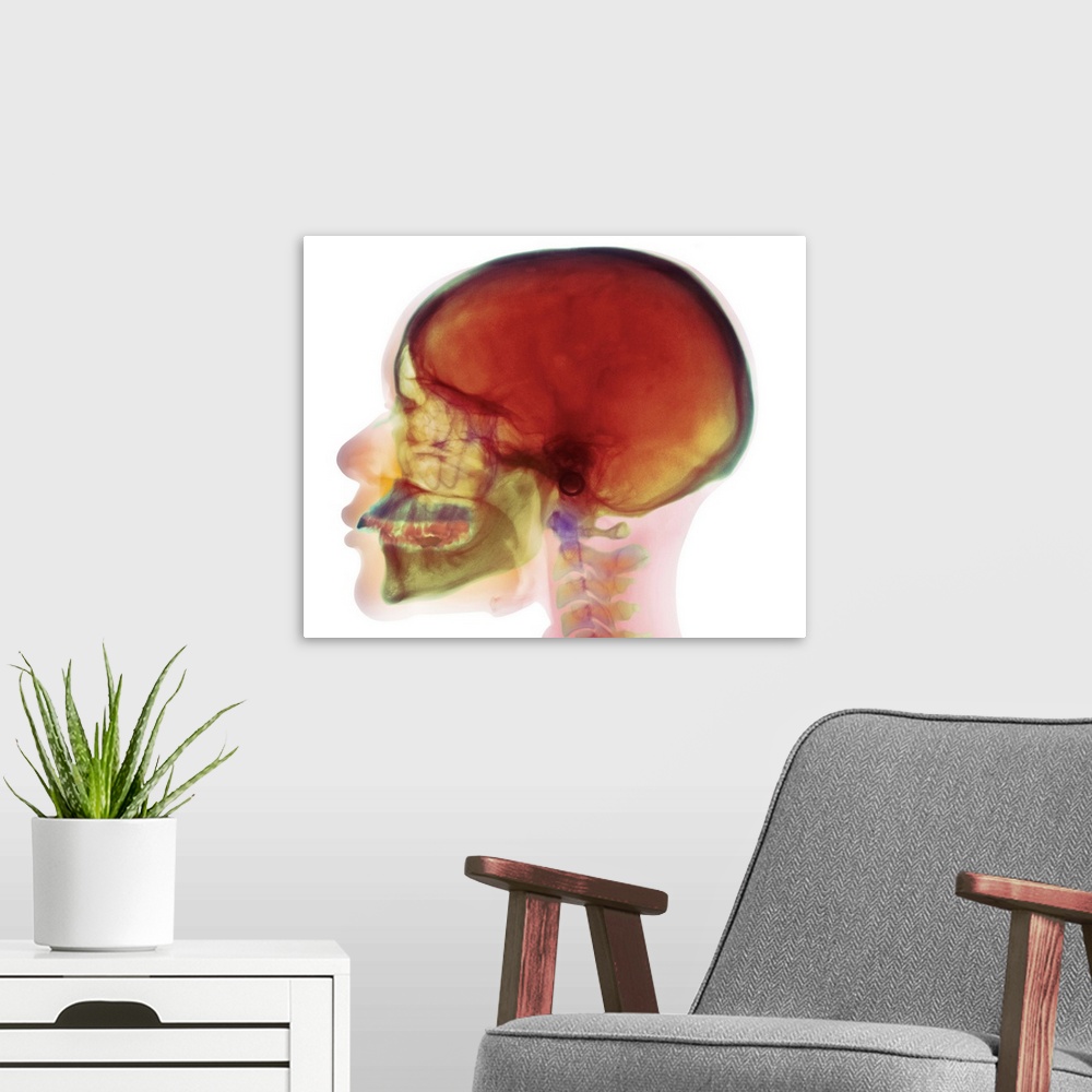 A modern room featuring Overbite. Coloured X-ray (side view) of the head of a 32 year old woman showing overbite of the u...