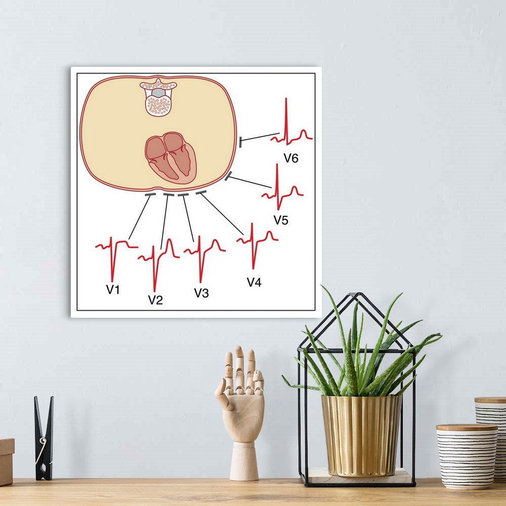 A bohemian room featuring Placing of electrodes for electrocardiogram (ECG), artwork. This diagram shows where the six elec...