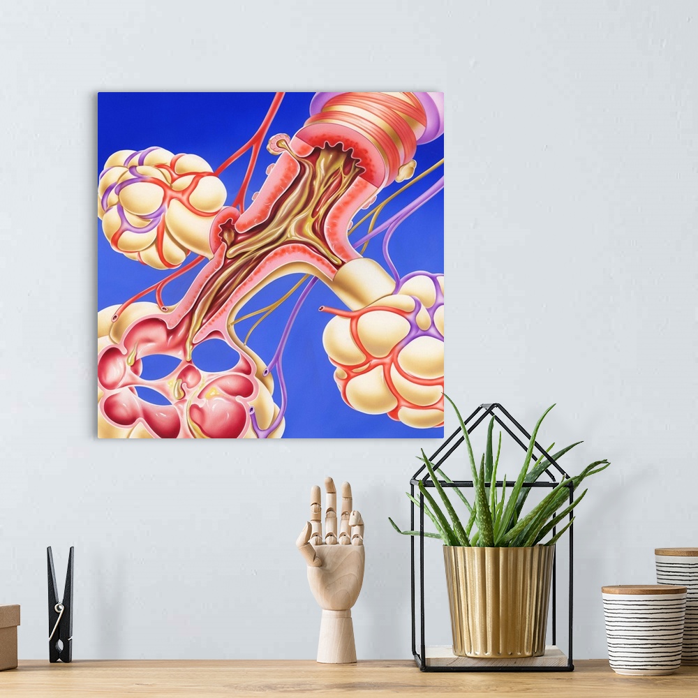 A bohemian room featuring Chronic obstructive pulmonary disease. Artwork of a bronchus and alveoli of the lungs in chronic ...
