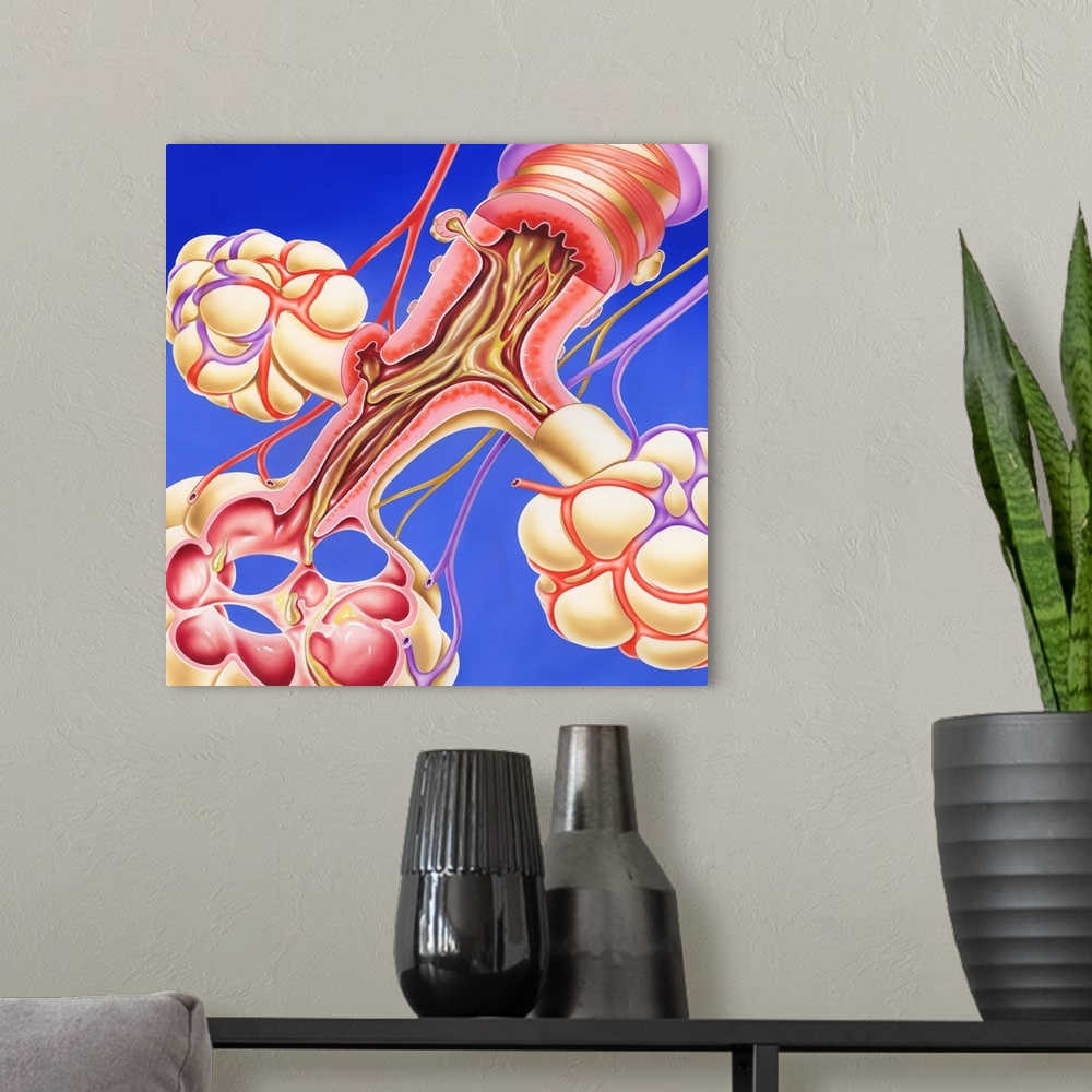 A modern room featuring Chronic obstructive pulmonary disease. Artwork of a bronchus and alveoli of the lungs in chronic ...
