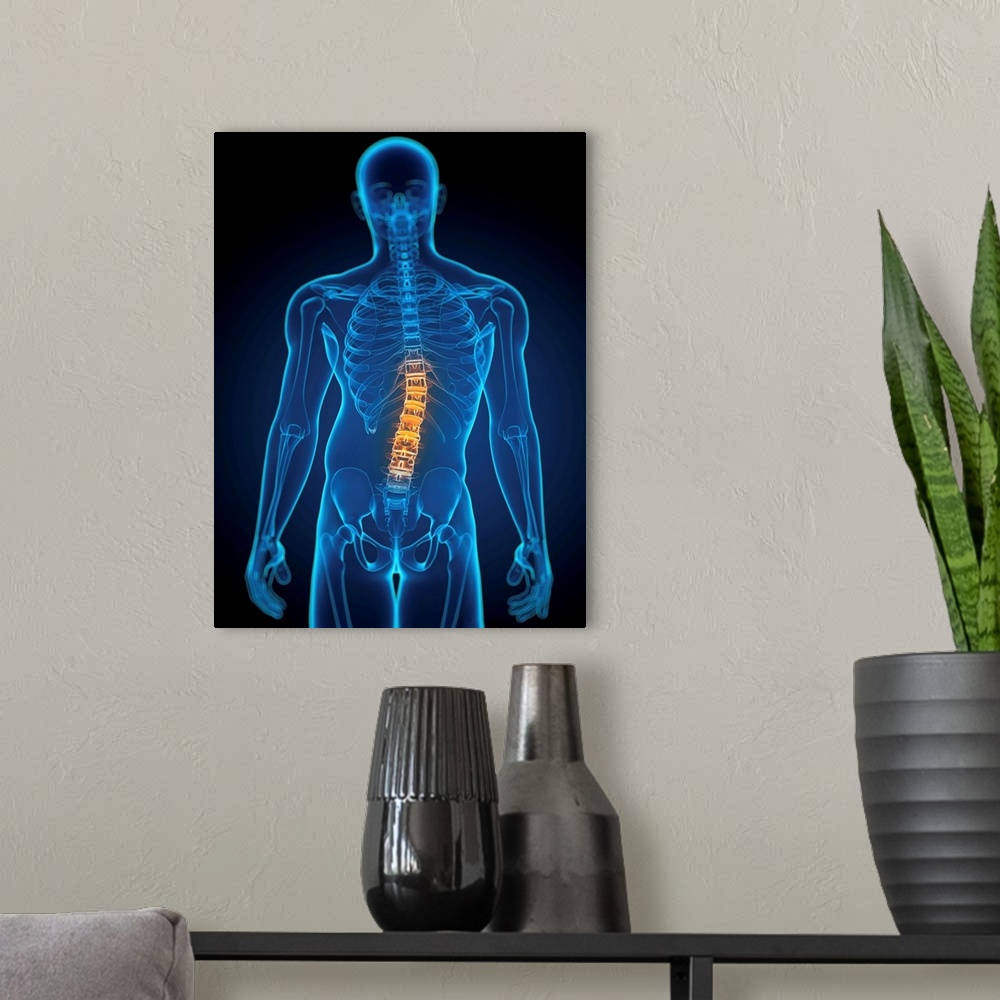 A modern room featuring Scoliosis. Computer artwork of a man with a sideways curvature (scoliosis) of the spine.
