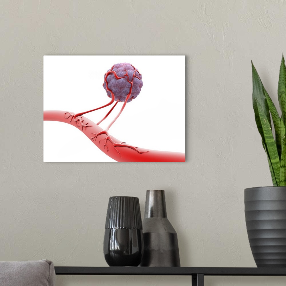 A modern room featuring Blood vessel formation. Artwork showing malignant (cancerous) tumour cells promoting the formatio...