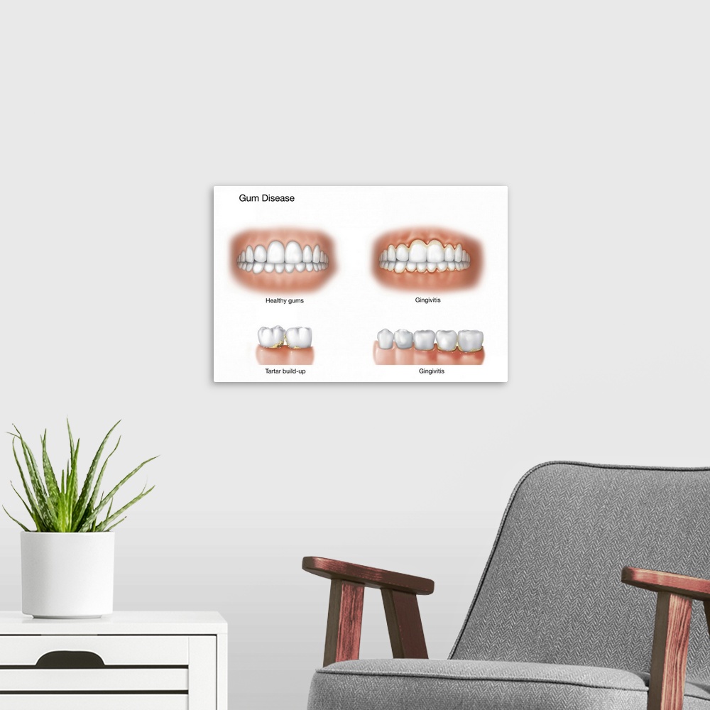 A modern room featuring Comparison of healthy gums versus gingivitis.