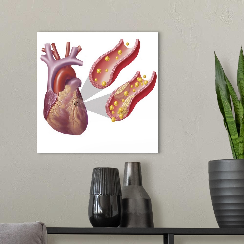 A modern room featuring Heart with arteries showing cholesterol in one artery and atherosclerotic plaque in the other.