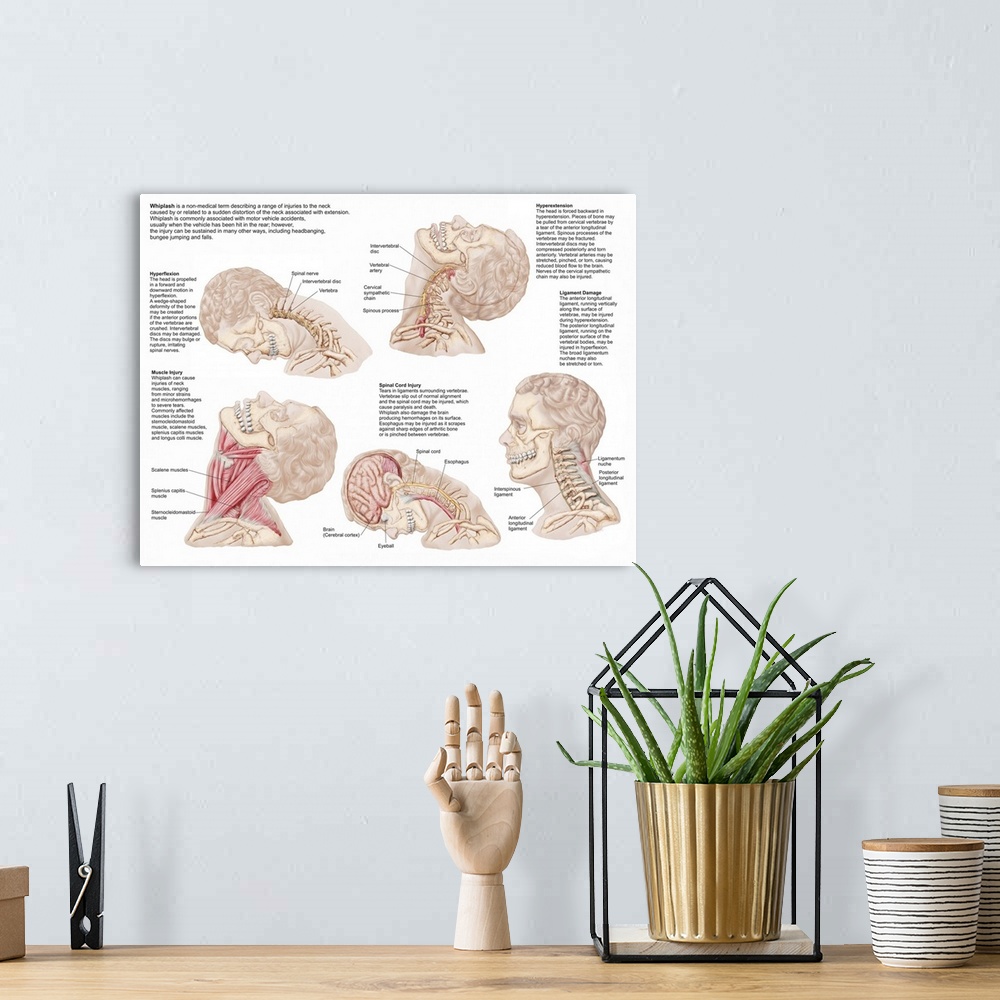 A bohemian room featuring Medical chart showing the range of injuries to the human neck caused by whiplash.