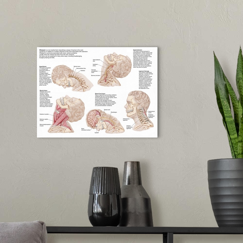 A modern room featuring Medical chart showing the range of injuries to the human neck caused by whiplash.