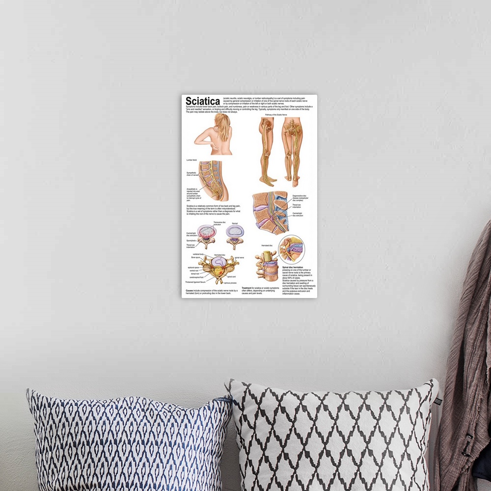 A bohemian room featuring Medical chart showing the signs and symptoms of sciatica.